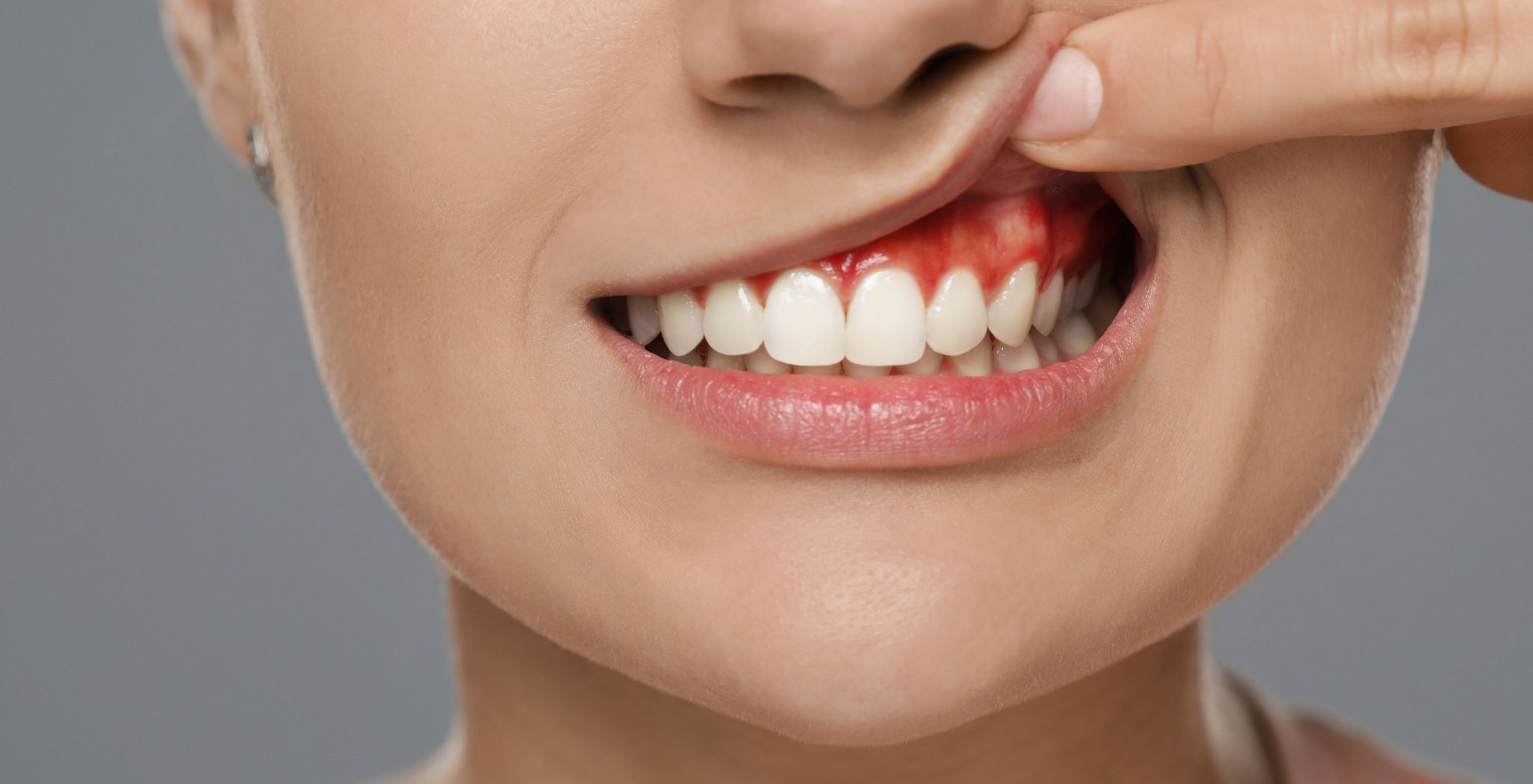 Gum disease stages, Gingivitis to periodontitis, Early gum disease signs, Stages of periodontal disease, Gum infection progression, Mild to severe gum disease, Symptoms of gum disease stages